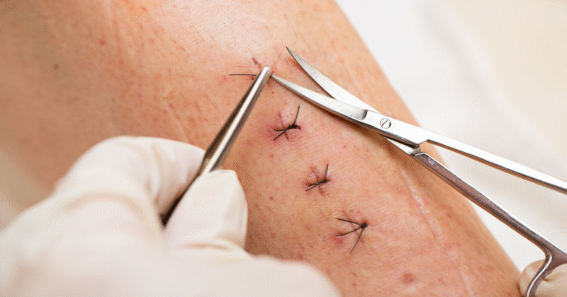 5-dau-hieu-nhiem-trung-vet-mo-can-tai-kham-ngay