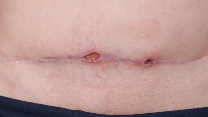 5-dau-hieu-nhiem-trung-vet-mo-can-tai-kham-ngay