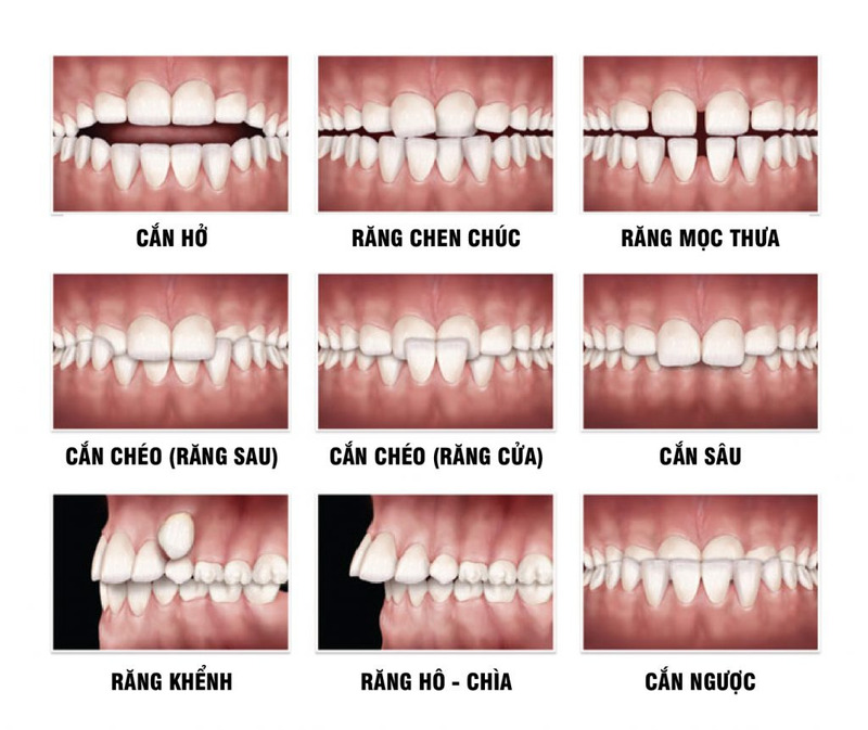 rang-lech-khop-can-lau-gay-hau-qua-gi-va-khi-nao.