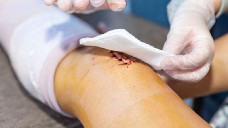 5-dau-hieu-nhiem-trung-vet-mo-can-tai-kham-ngay