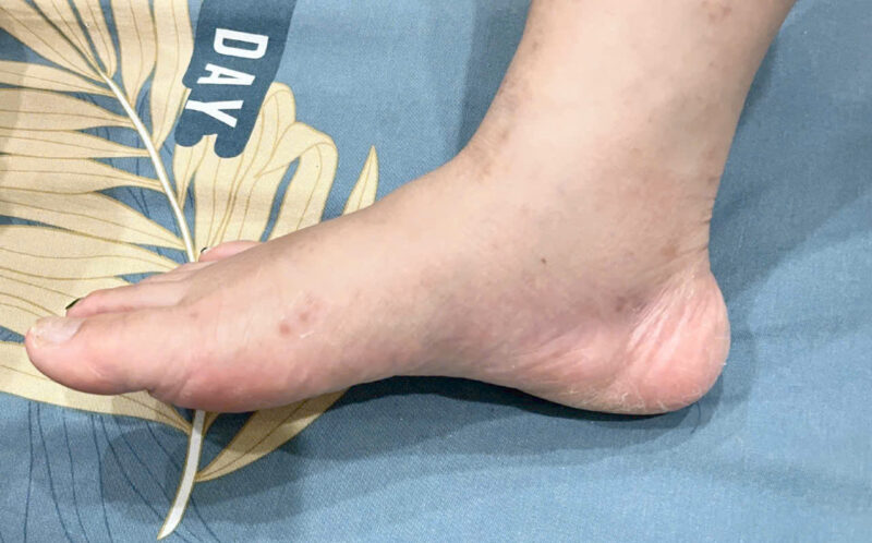 bong-gan-co-chan-5-sai-lam-khi-tu-dieu-tri-tai...