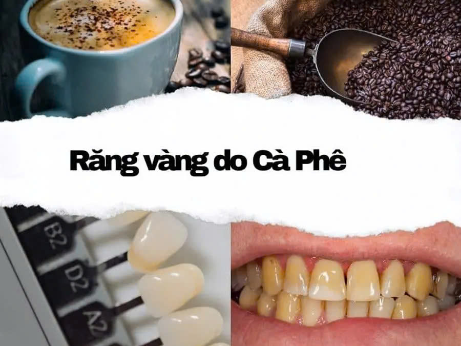 rang-bi-o-vang-xin-mau-du-khong-hut-thuoc