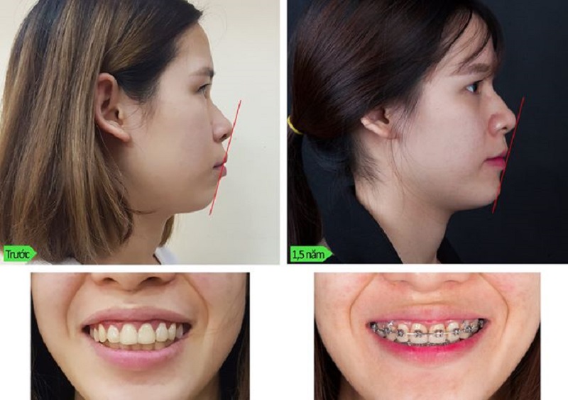 thoi-quen-an-nhai-lech-hau-qua-la-gi