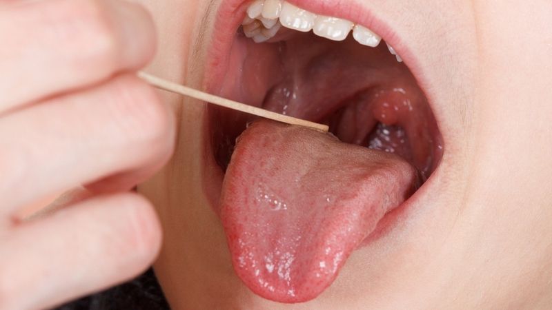 rang-mieng-va-benh-tim-mach-vi-khuan-rang-mieng..