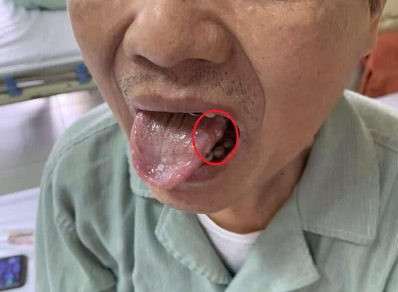 yeu-to-nao-lam-tang-nguy-co-ung-thu-khoang-mieng