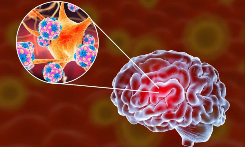 benh-nao-mo-cau-canh-bao-som-va-cach-phong-ngua