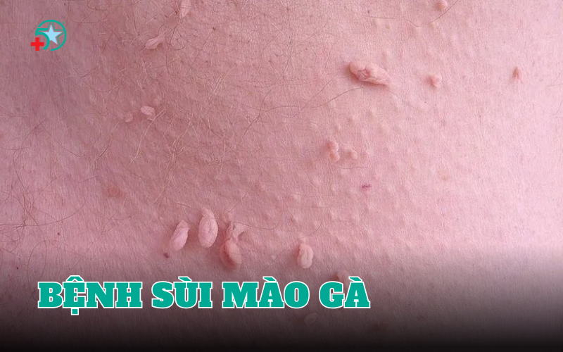 benh-sui-mao-ga-giai-doan-dau-co-bieu-hien-nao