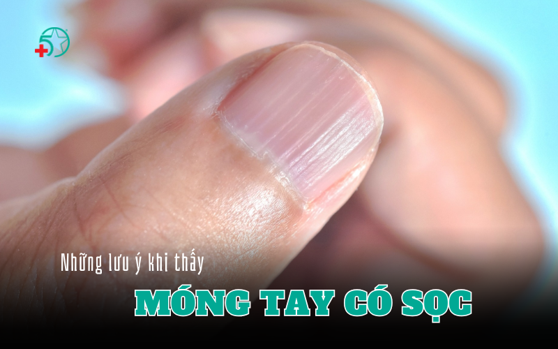 mong-tay-co-soc-doc-co-sao-khong-khi-nao-chi-la..
