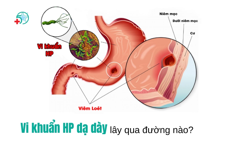vi-khuan-hp-da-day-lay-qua-duong-nao-khi-nao-nen